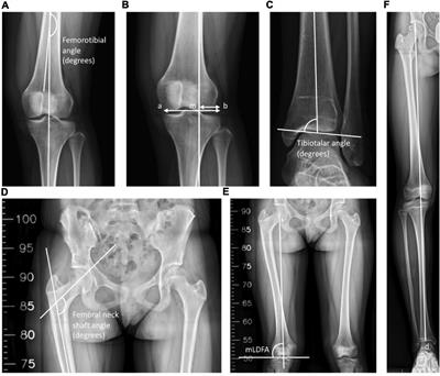 A Long-Term Study of Alignment Correction Following Proximal Femoral Varus Osteotomy and Pemberton Osteotomy in Children With Legg–Calvé–Perthes Disease and Developmental Dysplasia of the Hip